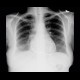 Constrictive pericarditis: X-ray - Plain radiograph