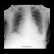 Constrictive pericarditis: X-ray - Plain radiograph