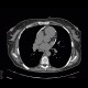 Constrictive pericarditis: CT - Computed tomography