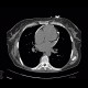 Constrictive pericarditis: CT - Computed tomography