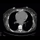 Constrictive pericarditis: CT - Computed tomography