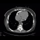 Constrictive pericarditis: CT - Computed tomography