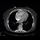 Constrictive pericarditis: CT - Computed tomography