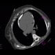 Constrictive pericarditis: CT - Computed tomography
