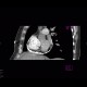 Constrictive pericarditis: CT - Computed tomography