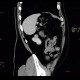 Renal carcinoma, small, detected on ultrasound, correlation of ultrasound and CT: CT - Computed tomography