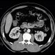 Renal carcinoma, small, detected on ultrasound, correlation of ultrasound and CT: CT - Computed tomography