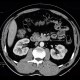 Renal carcinoma, small, detected on ultrasound, correlation of ultrasound and CT: CT - Computed tomography