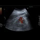 Renal carcinoma, small, detected on ultrasound, correlation of ultrasound and CT: US - Ultrasound