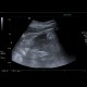 Renal carcinoma, small, detected on ultrasound, correlation of ultrasound and CT: US - Ultrasound