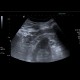 Renal carcinoma, small, detected on ultrasound, correlation of ultrasound and CT: US - Ultrasound