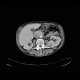 Renal carcinoma, correlation of ultrasound and CT: CT - Computed tomography