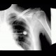 Bone infarct, secondary finding: X-ray - Plain radiograph