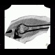 Bone infarct, secondary finding: CT - Computed tomography