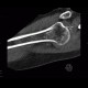 Bone infarct, secondary finding: CT - Computed tomography