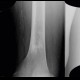 Bone infarction, atherosclerosis: X-ray - Plain radiograph