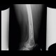 Bone infarction: X-ray - Plain radiograph