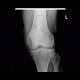 Bone infarction: X-ray - Plain radiograph