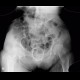 Vaginal pessary: X-ray - Plain radiograph
