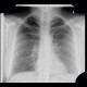 Cervical rib: X-ray - Plain radiograph