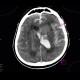 Intracranial aneurysm, subarachonid hemorrhage, hemocephalus: CT - Computed tomography