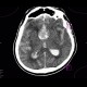 Intracranial aneurysm, subarachonid hemorrhage, hemocephalus: CT - Computed tomography