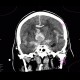 Intracranial aneurysm, subarachonid hemorrhage, hemocephalus: CT - Computed tomography