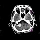 Intraparenchymal hemorrhage into cerebellum: CT - Computed tomography