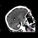 Intraparenchymal hemorrhage into cerebellum: CT - Computed tomography
