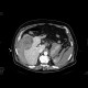 Hepatocellular carcinoma, ruptured, hemoperitoneum: CT - Computed tomography