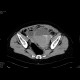 Bleeding into urinary bladder: CT - Computed tomography