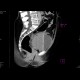 Bleeding into urinary bladder: CT - Computed tomography
