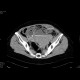 Bleeding into urinary bladder: CT - Computed tomography