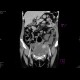 Bleeding into urinary bladder: CT - Computed tomography