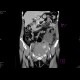 Bleeding into urinary bladder: CT - Computed tomography