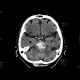 Intraparenchymal bleeding into pons: CT - Computed tomography