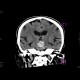 Intraparenchymal bleeding into pons: CT - Computed tomography