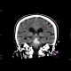 Intraparenchymal bleeding into pons: CT - Computed tomography