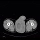 Complication of angiography, bleeding from groin, hematoma in scrotum, hemorrhage: CT - Computed tomography