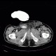 Complication of angiography, bleeding from groin, hematoma in scrotum, hemorrhage: CT - Computed tomography