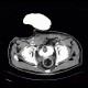 Complication of angiography, bleeding from groin, hematoma in scrotum, hemorrhage: CT - Computed tomography