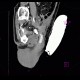 Complication of angiography, bleeding from groin, hematoma in scrotum, hemorrhage: CT - Computed tomography