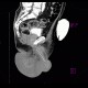 Complication of angiography, bleeding from groin, hematoma in scrotum, hemorrhage: CT - Computed tomography