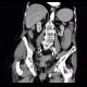 Intramural bleeding in small bowel, bowel wall, intramural hemorrhage: CT - Computed tomography