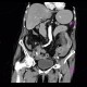 Intramural bleeding in small bowel, bowel wall, intramural hemorrhage: CT - Computed tomography