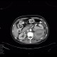 Perirenal hematoma after biopsy: CT - Computed tomography