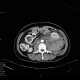 Perirenal hematoma after biopsy: CT - Computed tomography