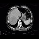 Hepatocellular adenoma, bleeding after biopsy: CT - Computed tomography