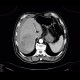 Hepatocellular adenoma, bleeding after biopsy: CT - Computed tomography