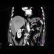 Hepatocellular adenoma, bleeding after biopsy: CT - Computed tomography